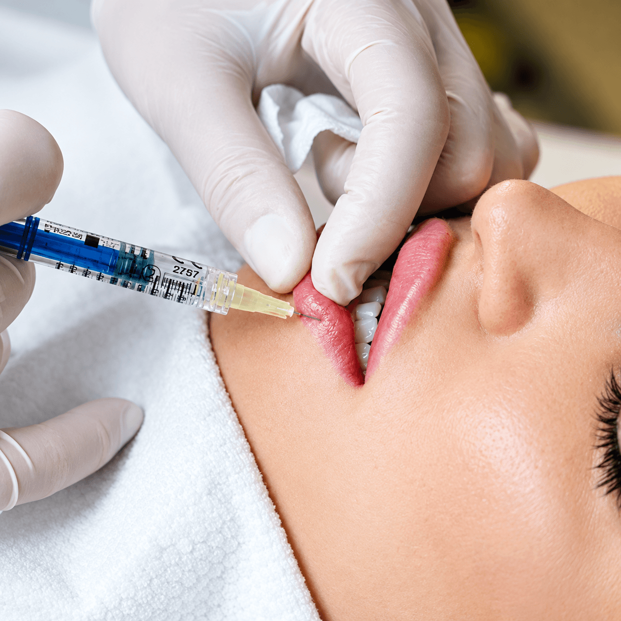 Lips Filler