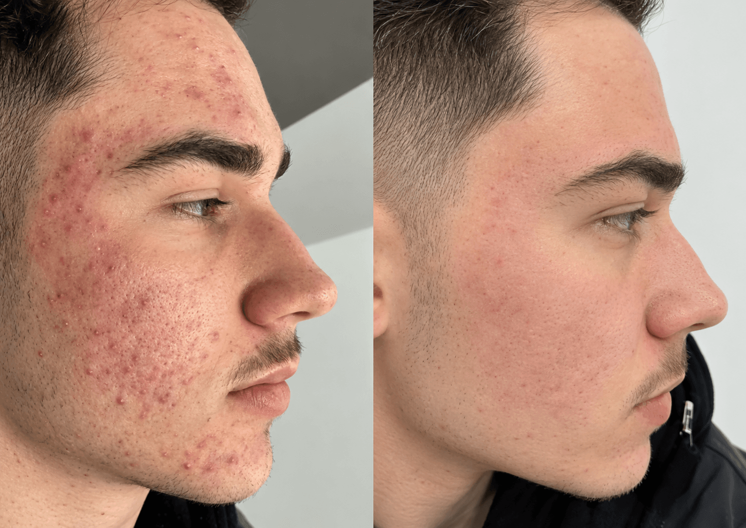 CO2 Laser Treatment