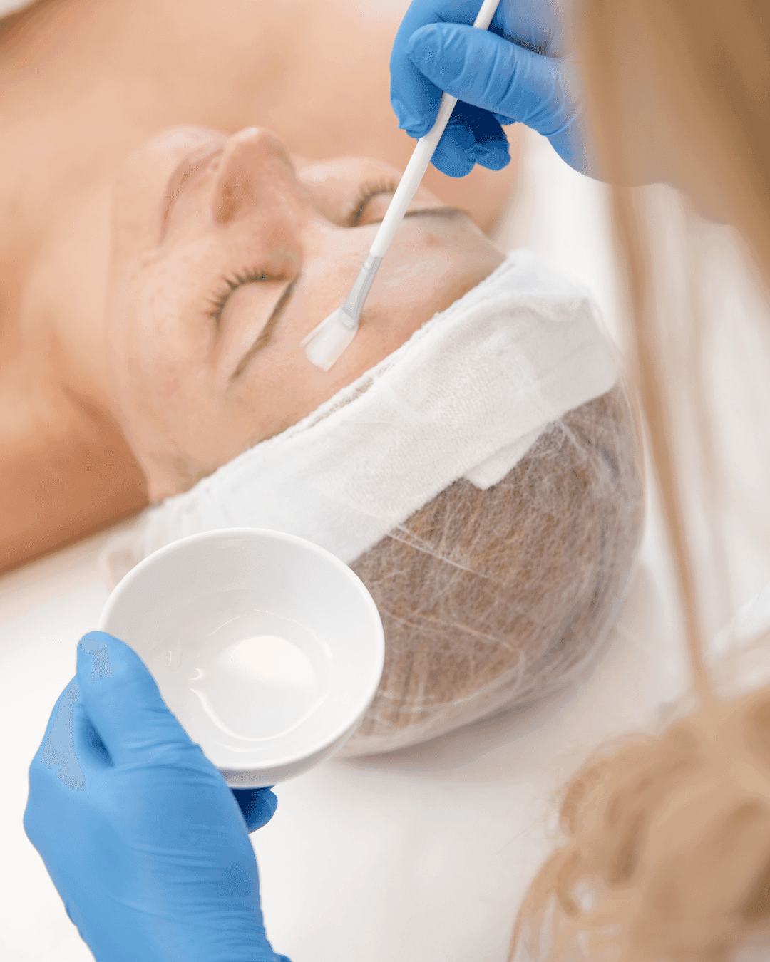 Chemical Peels Resurfacing