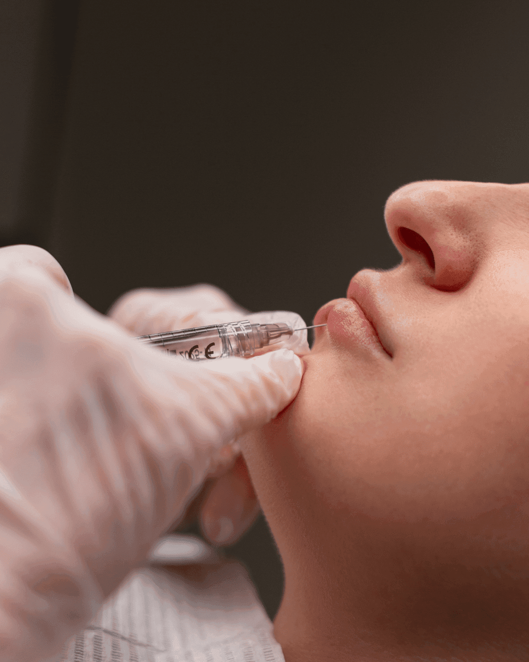Lips Filler