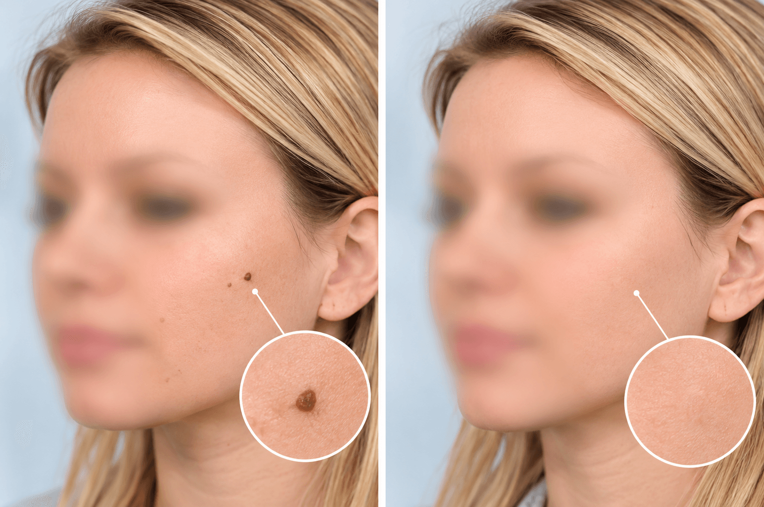 Precision Removal Treatment