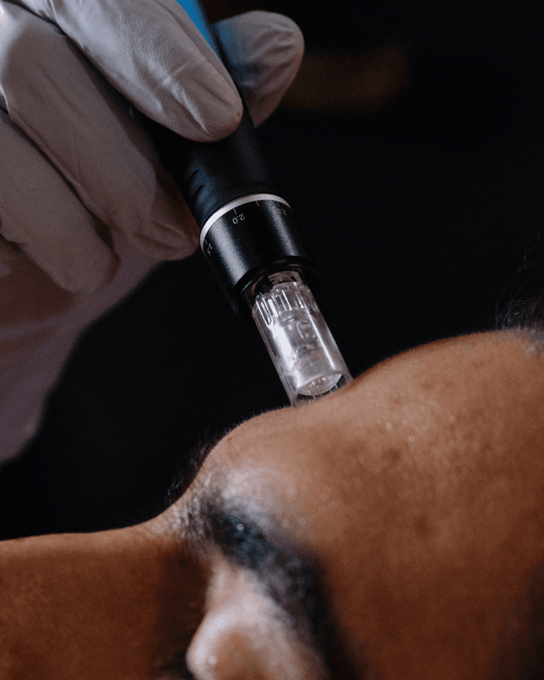Microneedling (Face & Hair)